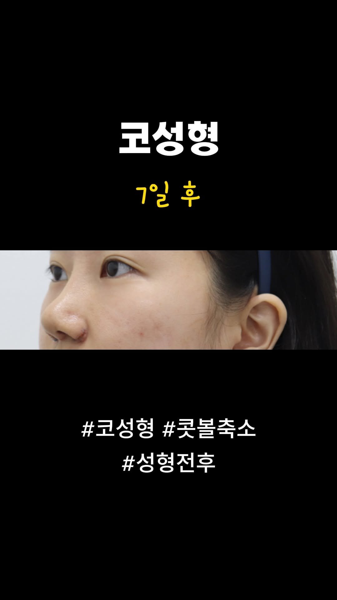 doctorsmips 게시물 이미지: 코성형, 콧볼축소 후기

#닥터스미성형외과 #성형후기 #코성형 #코수술 #성형전후 #콧볼축소