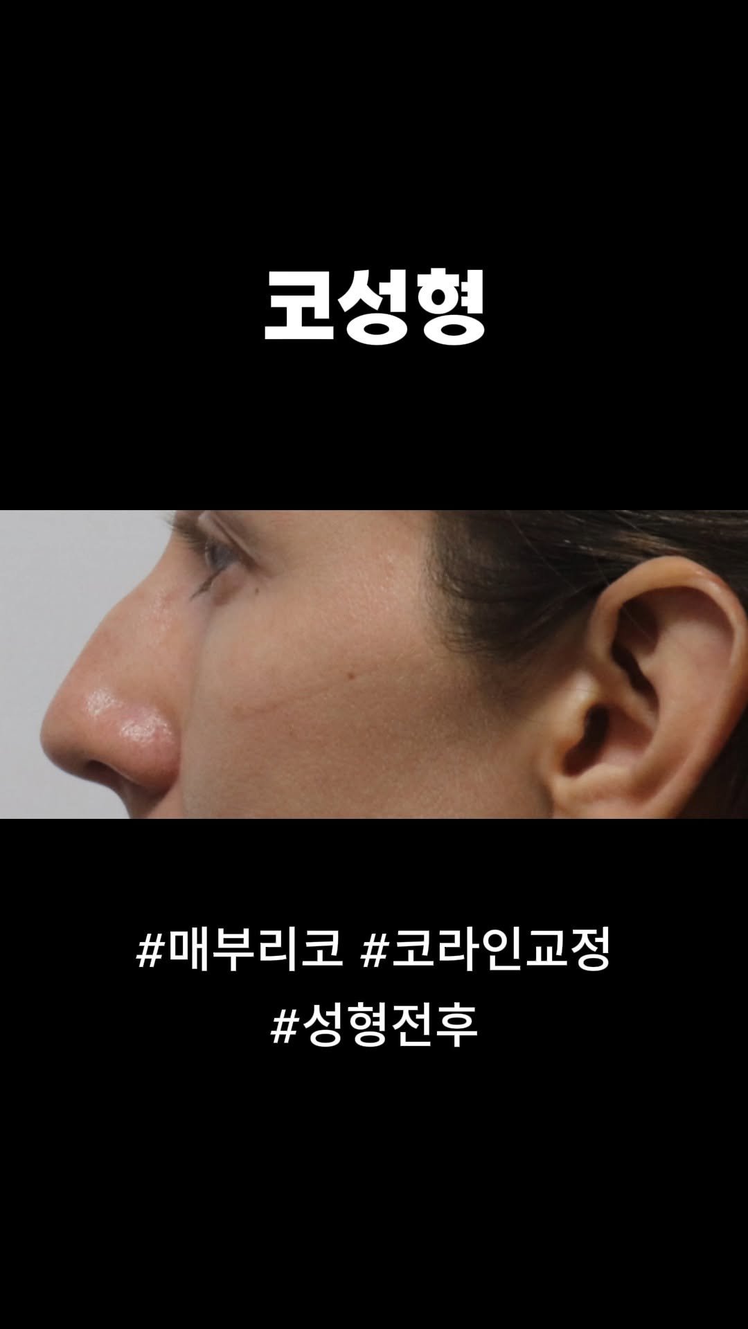 doctorsmips 게시물 이미지: 코성형 매부리코 라인교정
#닥터스미