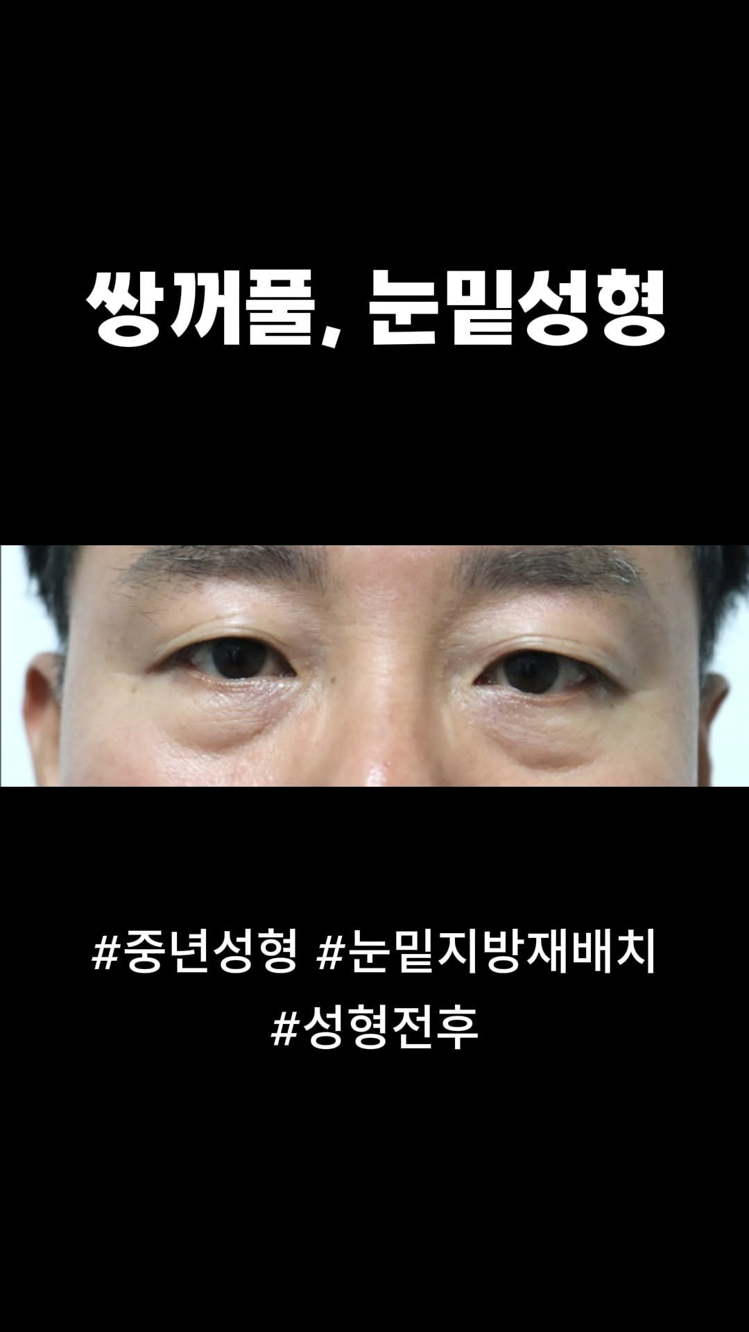 doctorsmips 게시물 이미지: 쌍꺼풀, 눈밑성형 후기

#닥터스미성형외과
#쌍꺼풀
#쌍꺼풀수술...