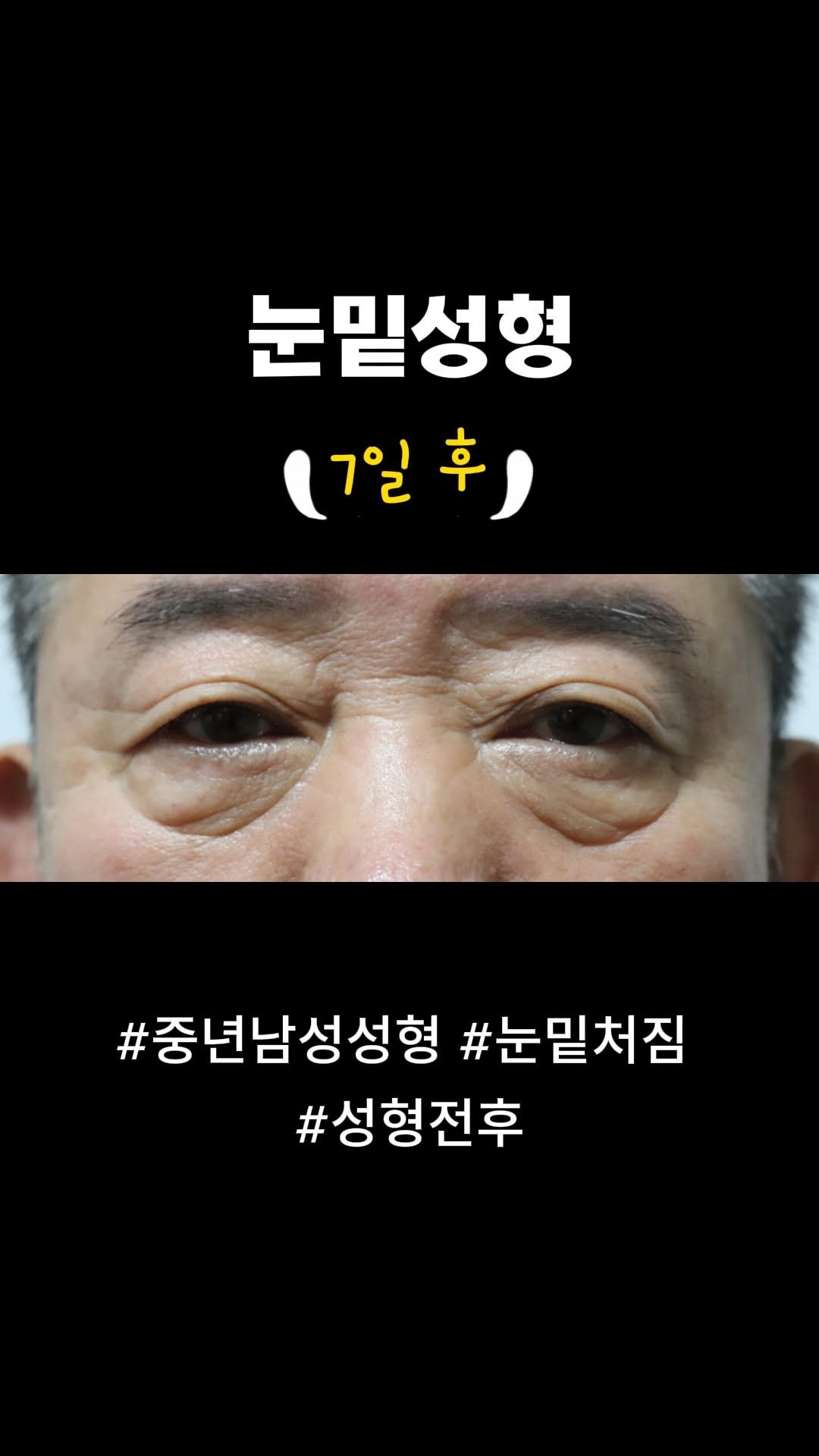 doctorsmips 게시물 이미지: 눈밑성형 전후 후기

#닥터스미성형외과
#눈밑지방재배치
#눈밑지방
#성형후기
#성형수술