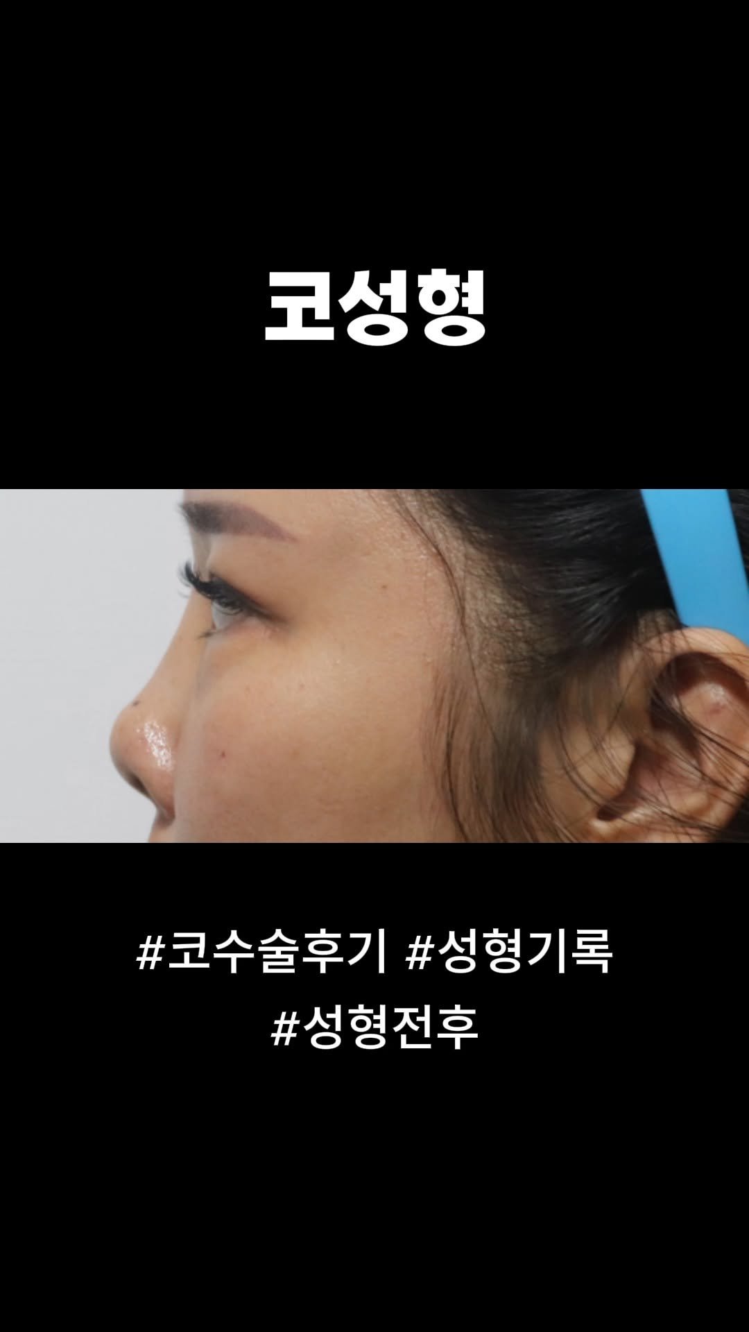 doctorsmips 게시물 이미지: 코성형 성형전후

#닥터스미성형외과 #코성형 #성형전후 #코성형후기 #성형후기