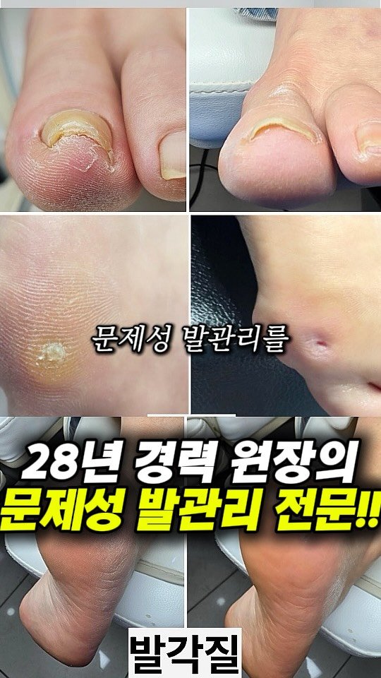 dongne_mukstagram 게시물 이미지: ⭕️10만원상당 이용권⭕️ 내성발톱 티눈등 문제성 발관리는 여기📝

📍풋시스

대구...