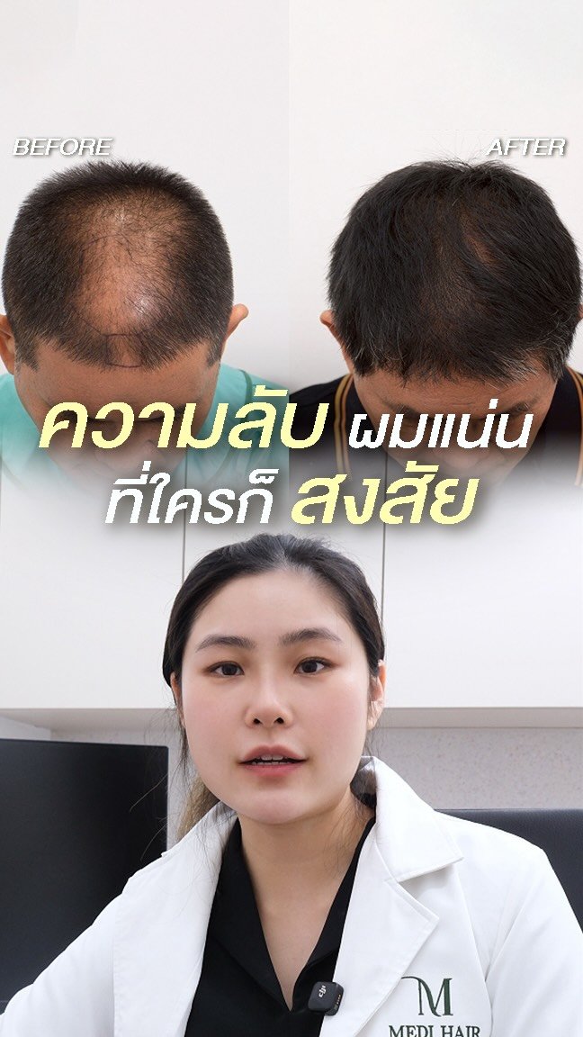 dr.aim_aphakorn 게시물 이미지: เคสตำรวจที่มีแต่คนทักว่าไปทำอะไรมา ทำไมผมแน่น