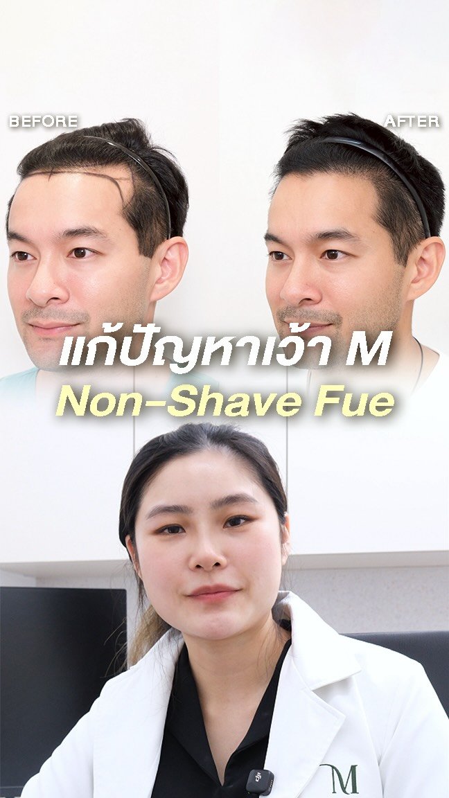 dr.aim_aphakorn 게시물 이미지: ปรับแนวไรผม แก้เว้า M คุณนิว เชื้ิอชาติ...