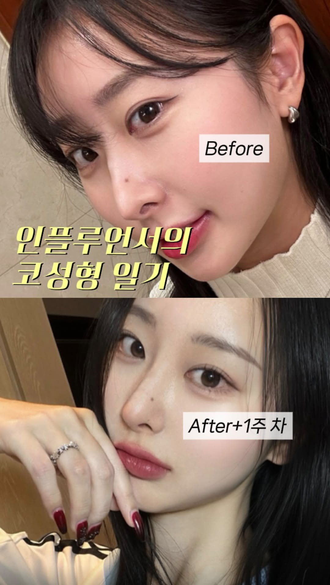 dr.by_kojel 게시물 이미지: 인플루언서의 코성형 후기!

안녕하세요. 코젤코의 아버지 ’닥터코젤‘...