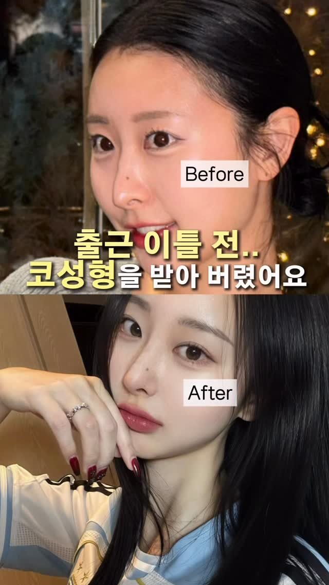 dr.by_kojel 게시물 이미지: 코수술 2일 후에 출근을?..

안녕하세요. 코젤코의 아버지 ’닥터코젤‘...