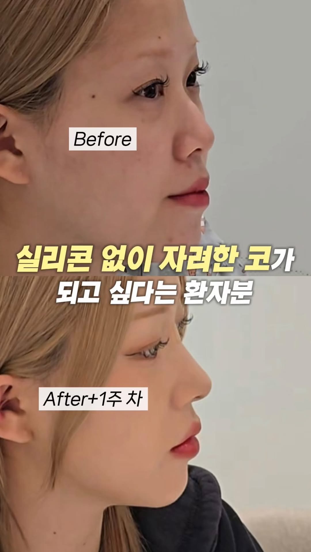 dr.by_kojel 게시물 이미지: 자려한 코 라인, 실리콘 없이 가능합니다!

안녕하세요. 코젤코의 아버지...