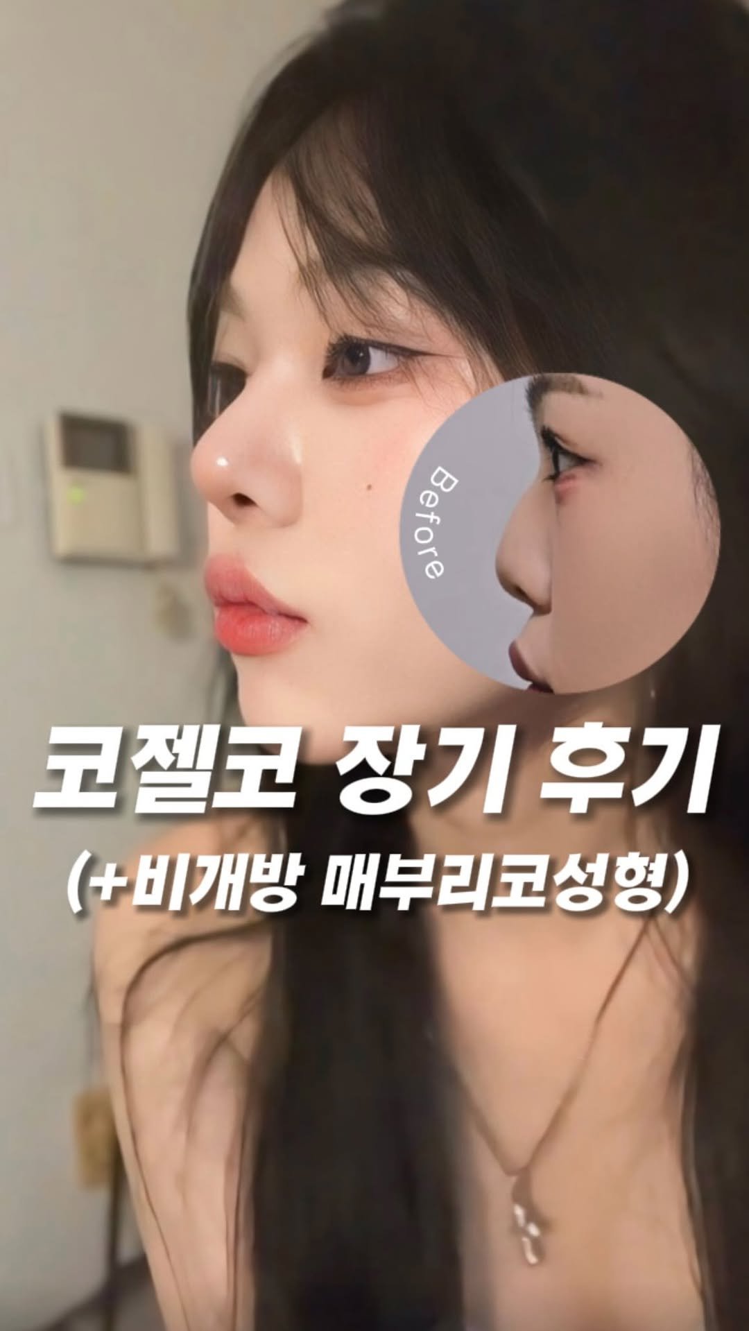 dr.by_kojel 게시물 이미지: 낮은 콧대, 매부리 모두 비개방으로!

안녕하세요. 코젤코의 아버지 ’닥터코젤‘...