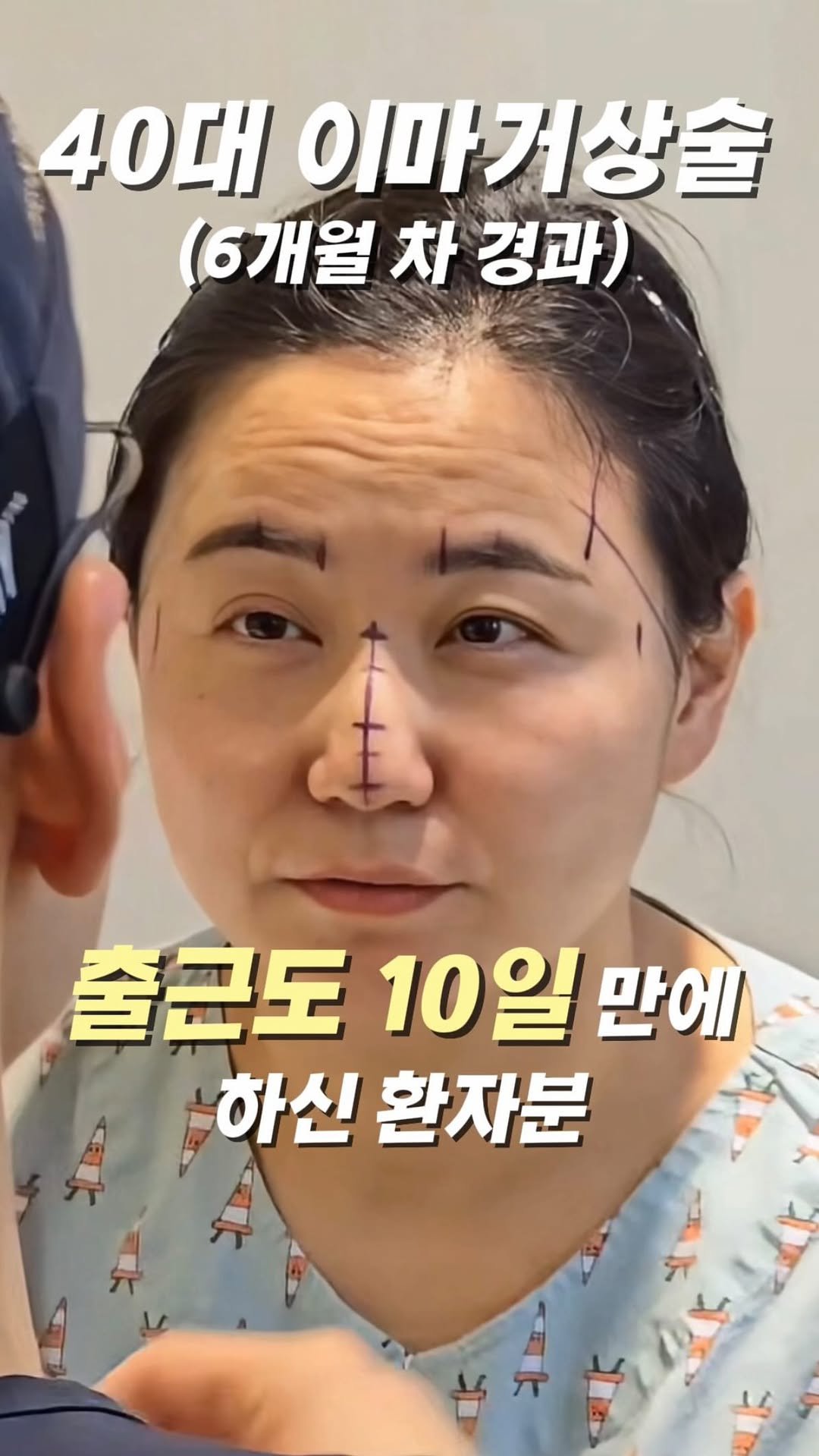 dr.by_kojel 게시물 이미지: 이마거상술 10일만에 출근 했다고?

안녕하세요. 코젤코의 아버지 ’닥터코젤‘...