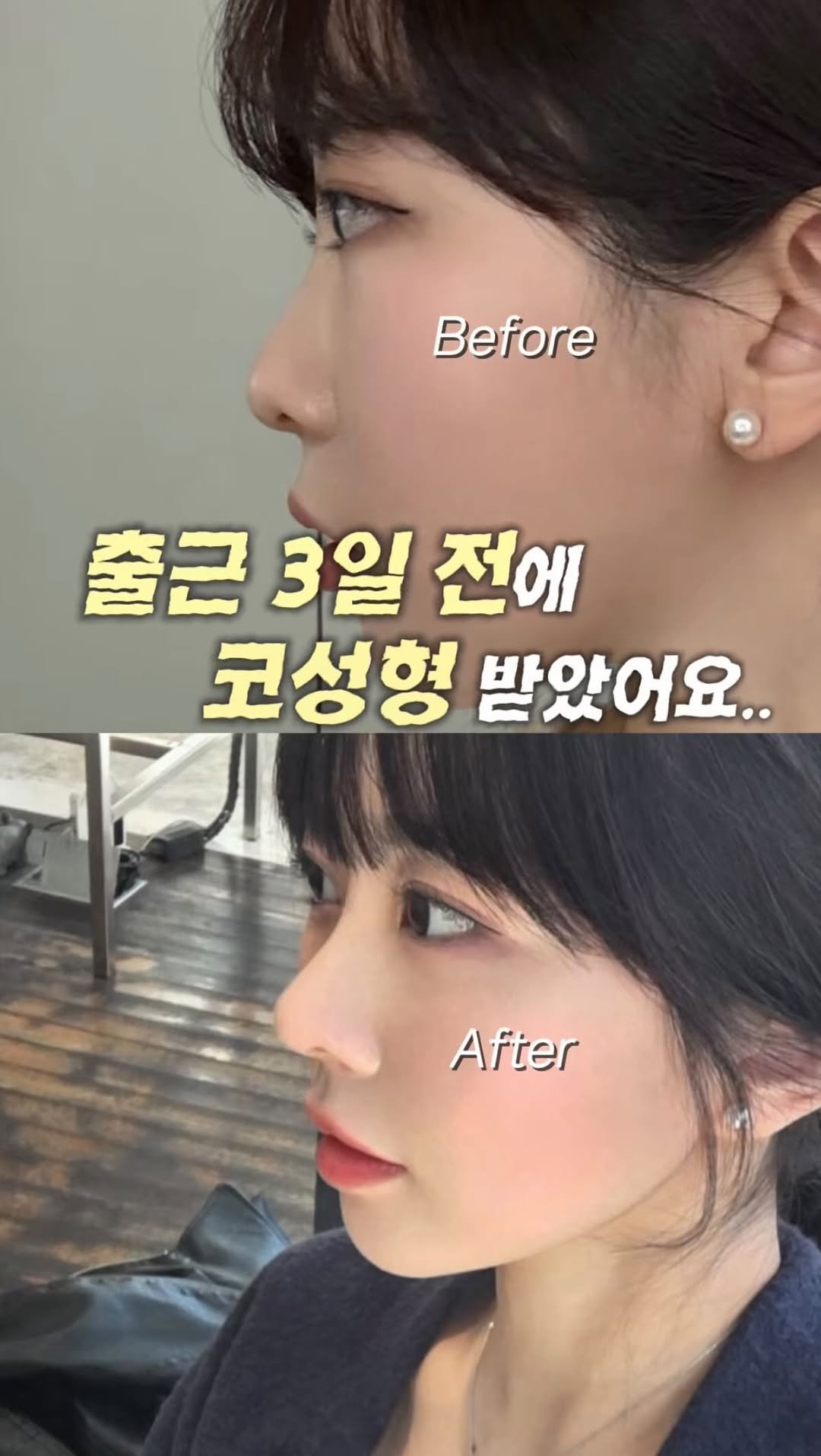 dr.by_kojel 게시물 이미지: 무보형물코성형, 정말 낮은 코도 가능한가요?

안녕하세요. 코젤코의 아버지...