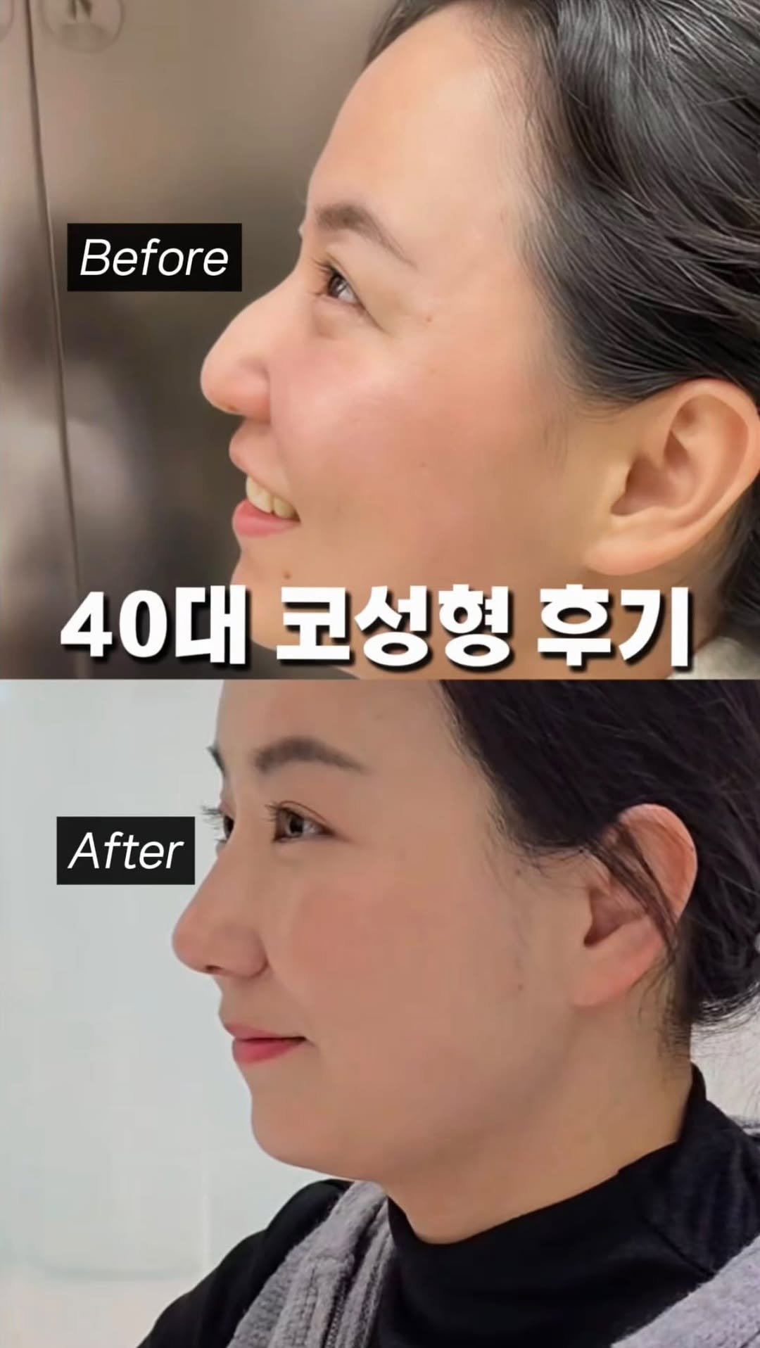 dr.by_kojel 게시물 이미지: 중년들도 부담 없이 받을 수 있는 코성형!

안녕하세요. 코젤코의 아버지...