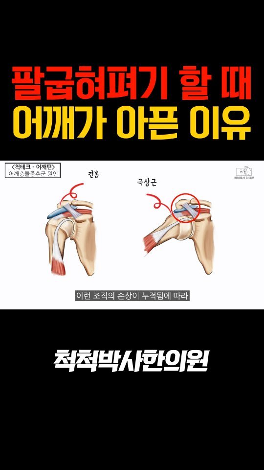 dr.chukchuk_clinic 게시물 이미지: 팔굽혀펴기 후
어깨 앞쪽이 욱신거린다면 🤔
단순 근육통이 아닐 수 있습니다.
운동을...