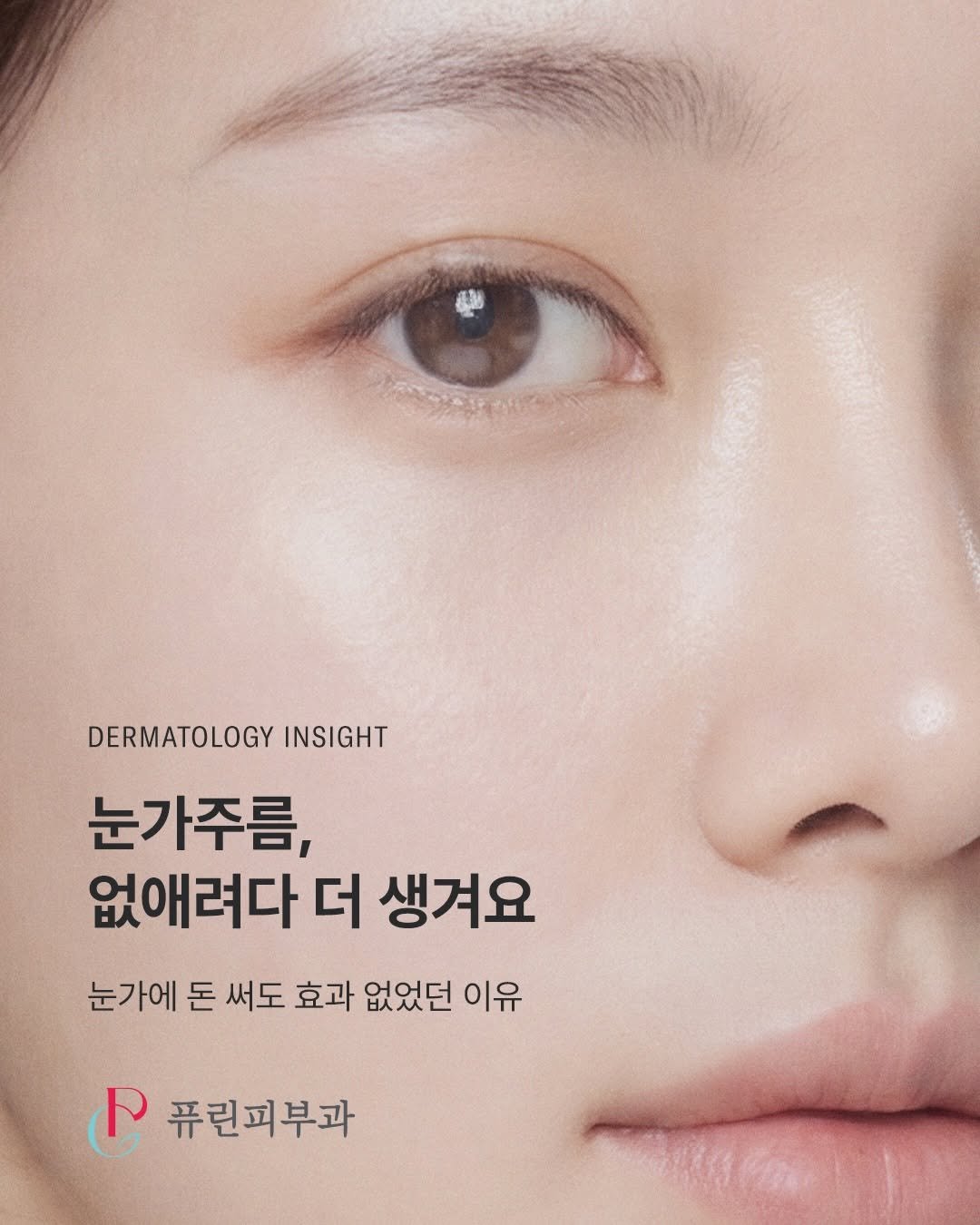 dr.pureen 게시물 이미지: 눈가주름, 없애려다 더 생겨요 👁️

돈 써도 안 됐던 거, 이유...