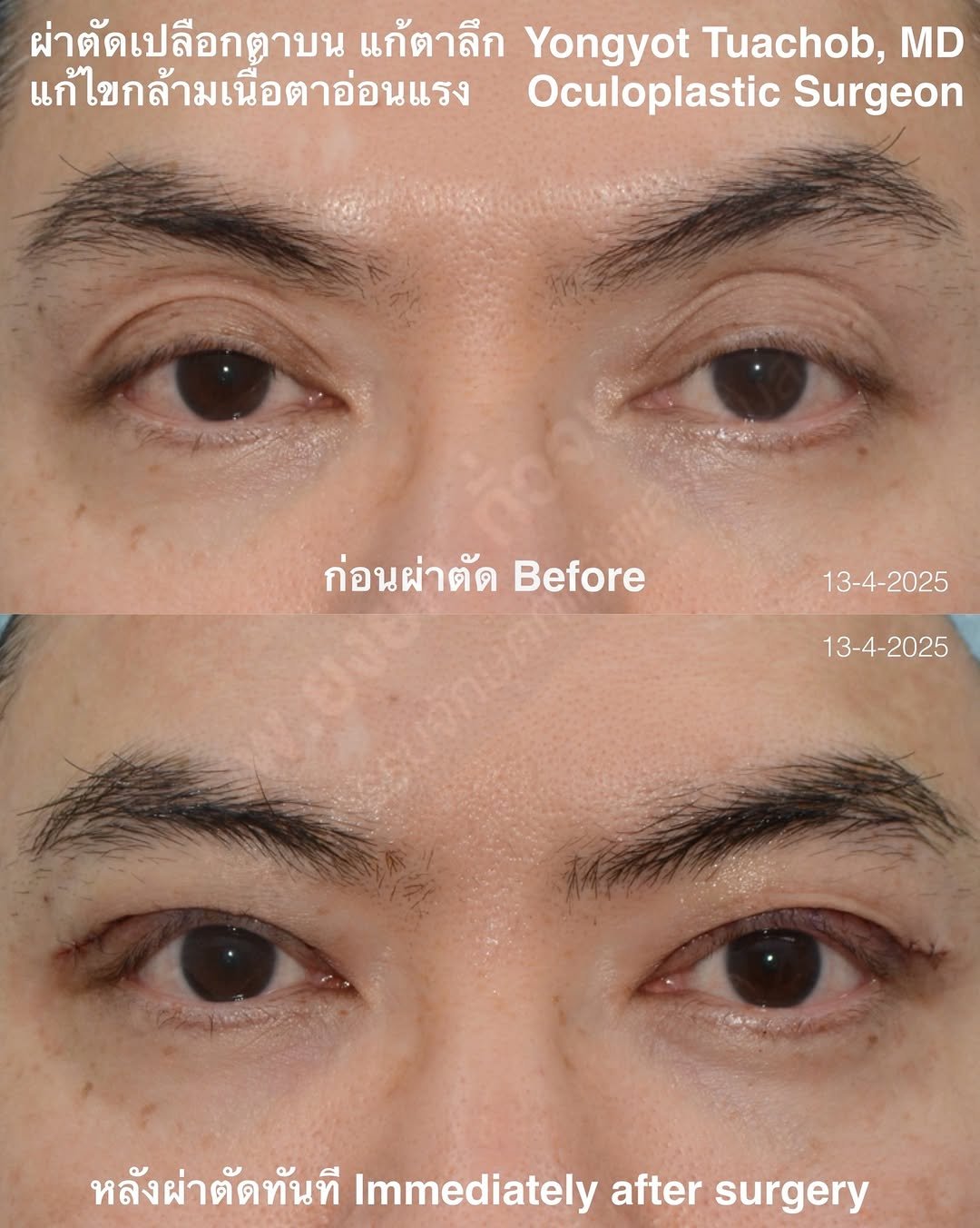 dr.yongyot_eyelid 게시물 이미지: ผ่าตัดแก้เบ้าตาลึก และแก้กล้ามเนื้อตาอ่อนแรง...