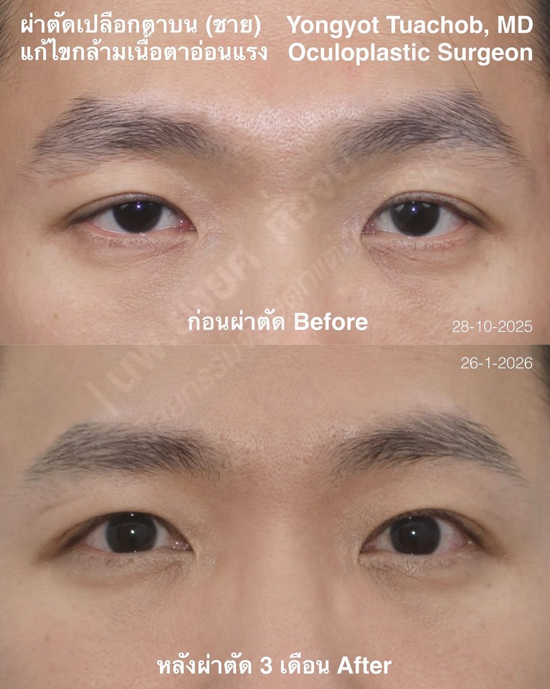 dr.yongyot_eyelid 게시물 이미지: ผ่าตัดตาสองชั้น แก้กล้ามเนื้อตาอ่อนแรง...