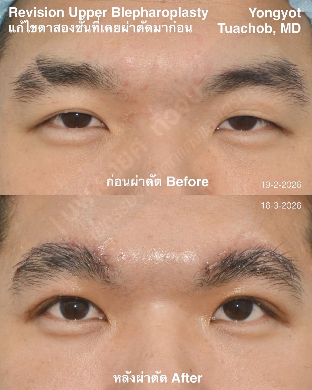 dr.yongyot_eyelid 게시물 이미지: ผ่าตัด...