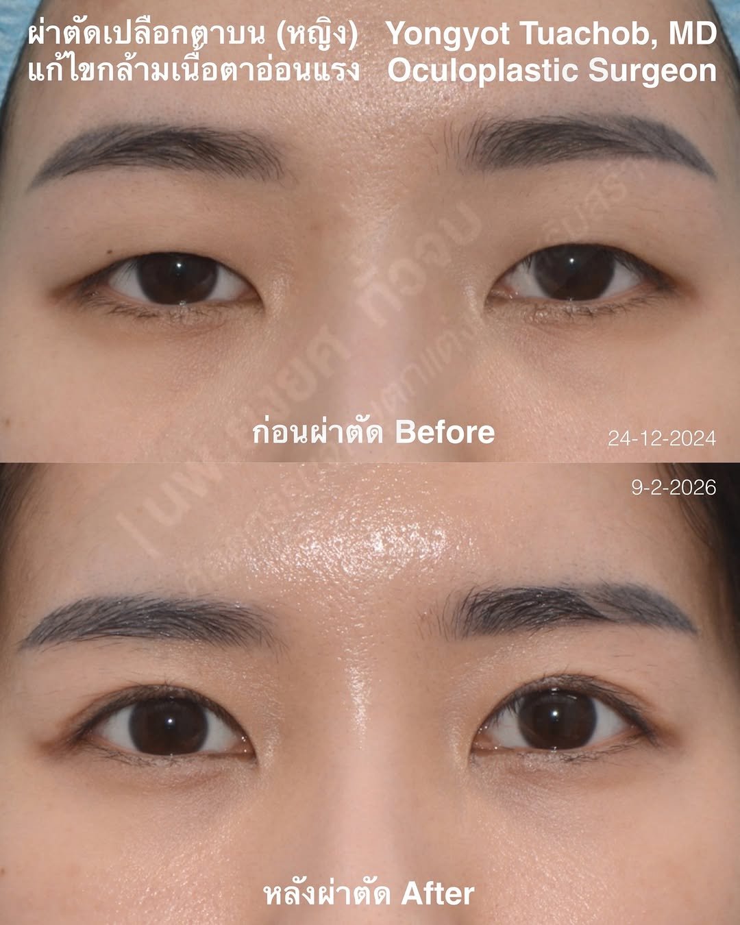 dr.yongyot_eyelid 게시물 이미지: ผ่าตัดตาสองชั้น แก้กล้ามเนื้อตาอ่อนแรง...