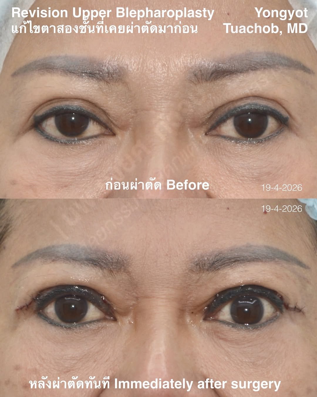 dr.yongyot_eyelid 게시물 이미지: ผ่าตัด “เคสแก้” ตาสองชั้นที่เคยผ่าตัดมาก่อน...