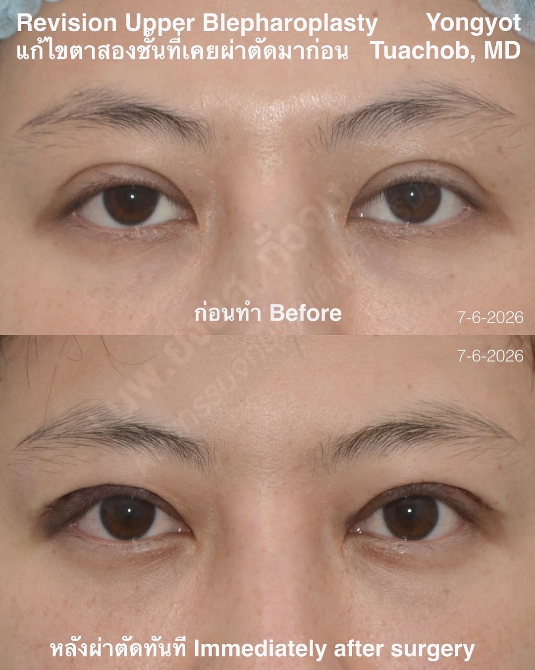 dr.yongyot_eyelid 게시물 이미지: ผ่าตัด “เคสแก้” ตาสองชั้นที่เคยผ่าตัดมาก่อน...