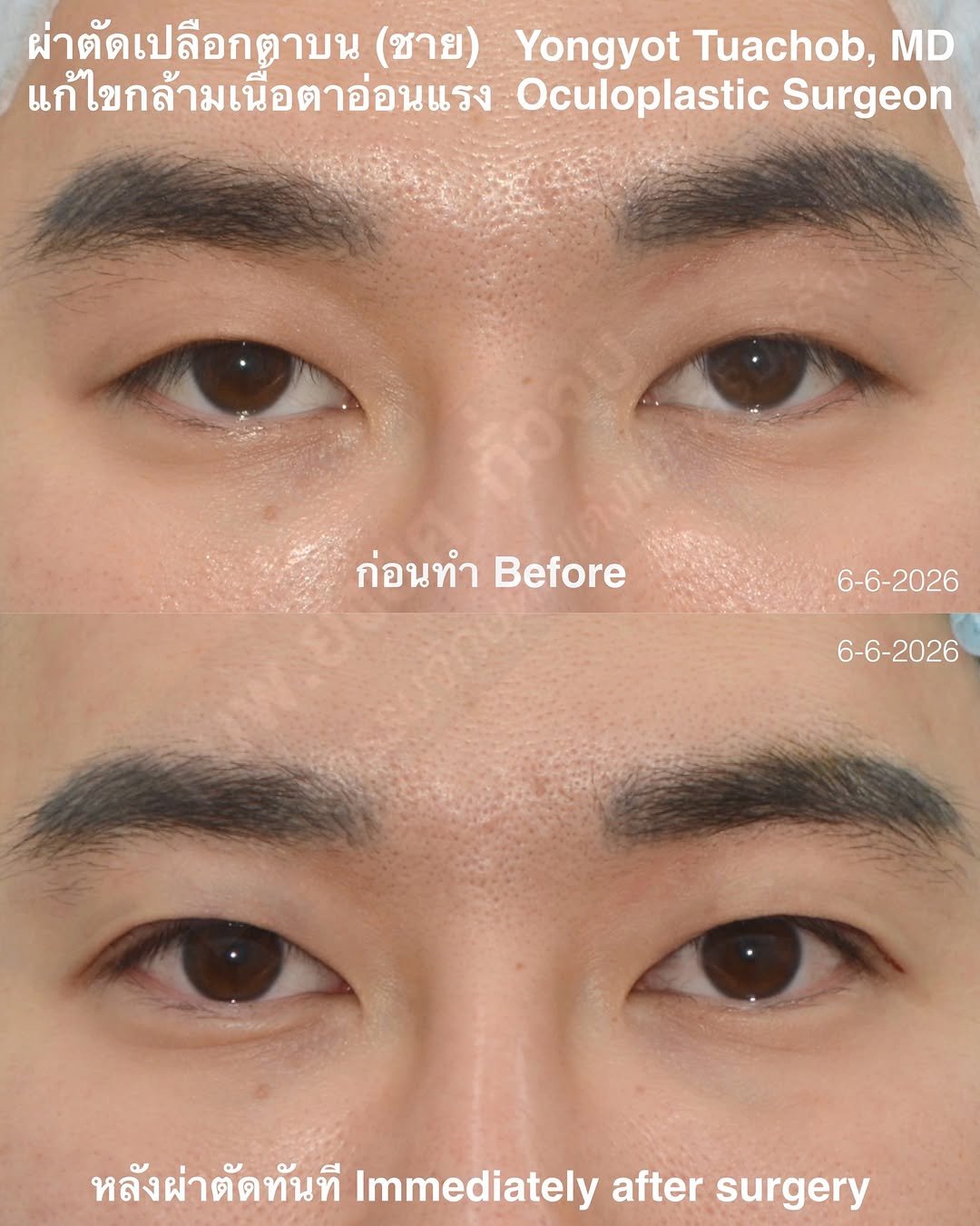 dr.yongyot_eyelid 게시물 이미지: ผ่าตัดตาสองชั้น แก้กล้ามเนื้อตาอ่อนแรง (ชาย)...