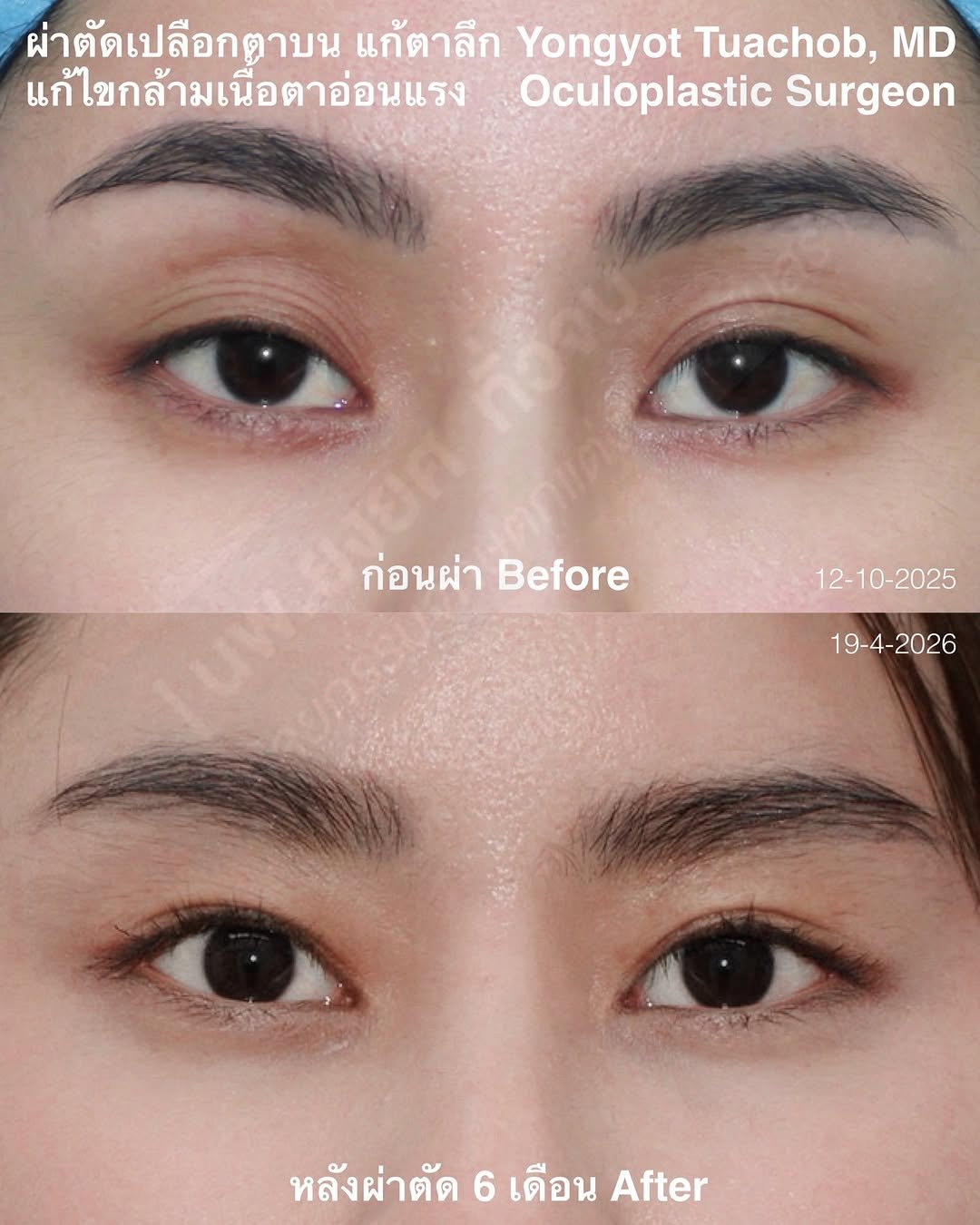 dr.yongyot_eyelid 게시물 이미지: ผ่าตัดแก้เบ้าตาลึก...