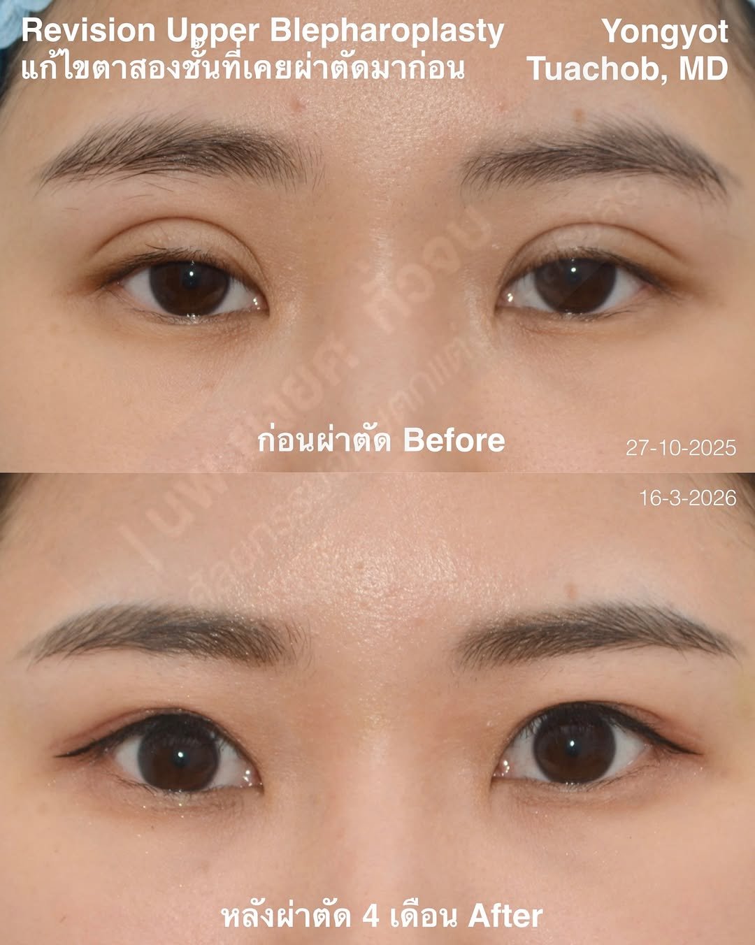 dr.yongyot_eyelid 게시물 이미지: ผ่าตัด “เคสแก้ตาหอยแครง “
**ผลลัพธ์หลังผ่า 4...