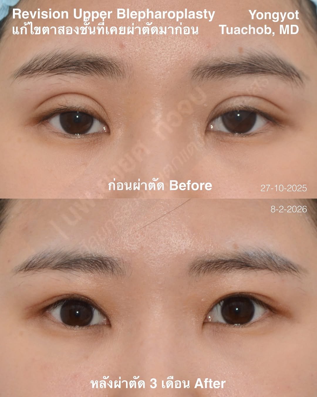 dr.yongyot_eyelid 게시물 이미지: ผ่าตัด ”เคสแก้ตาหอยแครง “
**ผลลัพธ์หลังผ่า 3...