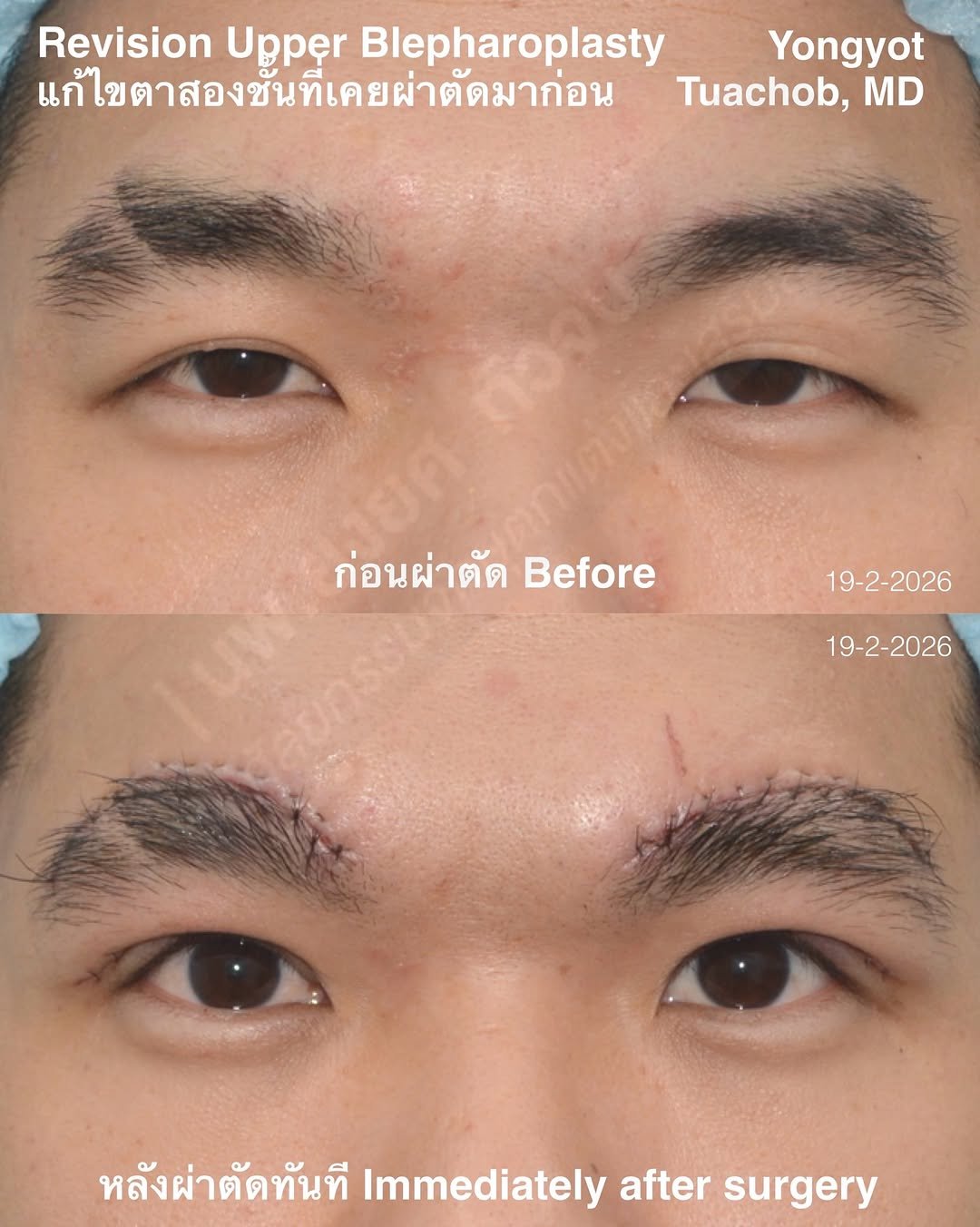 dr.yongyot_eyelid 게시물 이미지: ผ่าตัด...