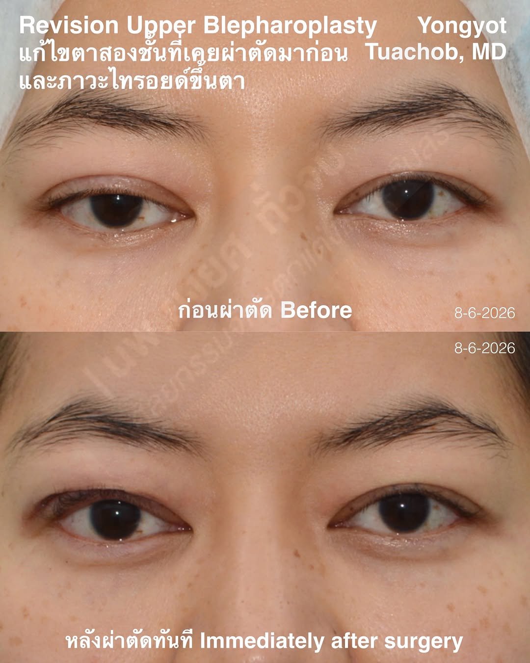 dr.yongyot_eyelid 게시물 이미지: ผ่าตัด “เคสแก้” ตาสองชั้นที่เคยผ่าตัดมาก่อน...