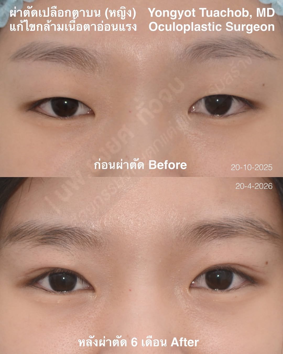 dr.yongyot_eyelid 게시물 이미지: ผ่าตัดแก้ไขกล้ามเนื้อตาอ่อนแรง -...