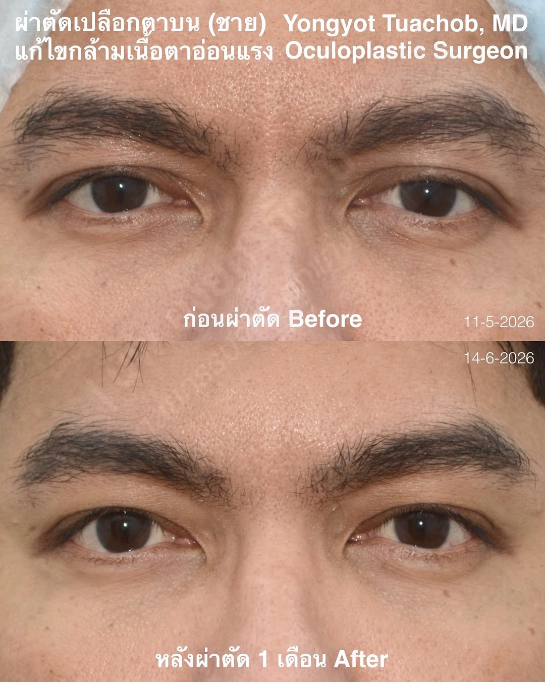 dr.yongyot_eyelid 게시물 이미지: ผ่าตัดตาสองชั้น แก้กล้ามเนื้อตาอ่อนแรง...