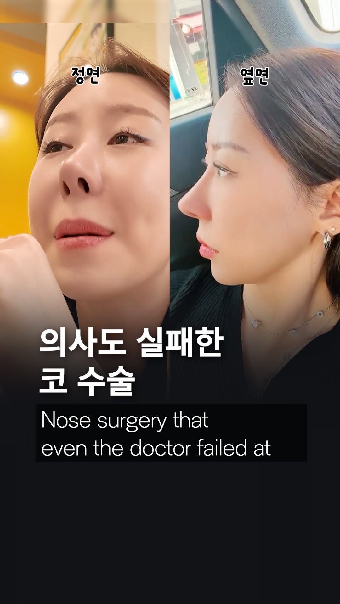 dr_ohmi 게시물 이미지: “코 수술 진짜 하지 마세요.”

원장님이
제 코 수술을 계속 말렸던 이유...