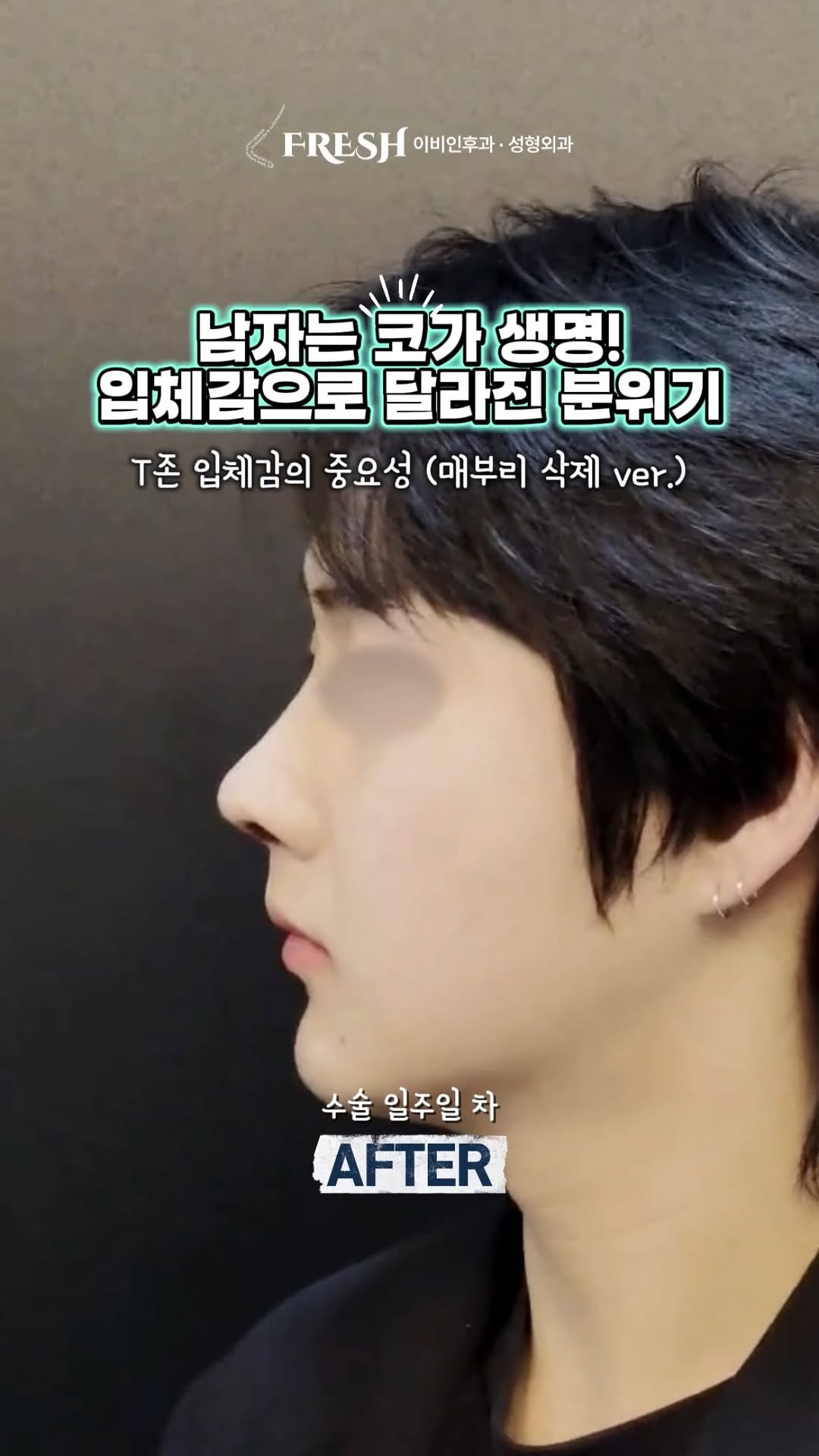 dr_taehwan_ahn 게시물 이미지: 기능은 확실하게, 라인은 완벽하게! 👃✨

휜 코와 비중격 만곡증으로 인한 코막힘,...