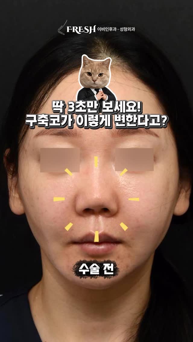 dr_taehwan_ahn 게시물 이미지: 딱 3초만 보세요! 구축코가 이렇게 변한다고? 🤯

요즘 예쁜 언니들은 코에 실리콘...