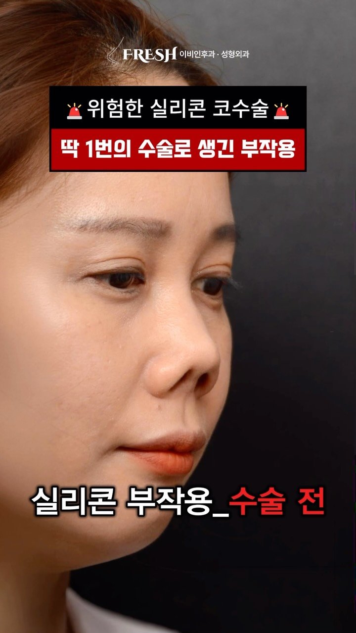 dr_taehwan_ahn 게시물 이미지: [ 실리콘 부작용으로 딱딱하게 굳고 들린 코, 회복 가능할까? 🥺 ]

멀리...