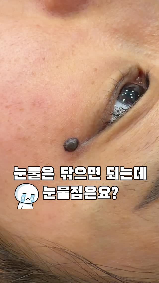 dr_yunwonseok 게시물 이미지: 내가 운 게 아니라 점이 운 겁니다

눈물은 닦으면 되지만,
눈물점은 고민된다면...