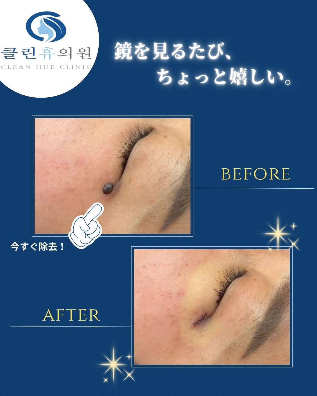 dr_yunwonseok 게시물 이미지: ⁡.
鏡を見るたび、ちょっと嬉しい肌へ。

気になっていたイボも、
すっきり自然に除去できます...