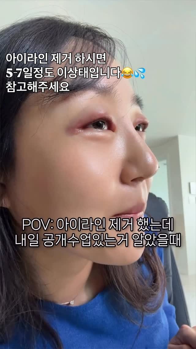 dr_yunwonseok 게시물 이미지: 아이라인 제거