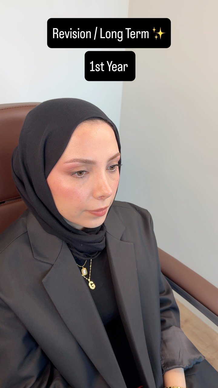drfurkanozer 게시물 이미지: ✨ 1-Year Long-Term Revision Rhinoplasty...