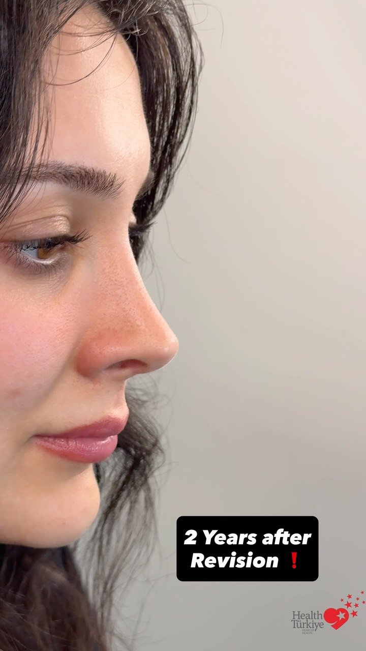 drfurkanozer 게시물 이미지: ✨ 2 YEARS LATER — Revision Rhinoplasty 🔥

When...