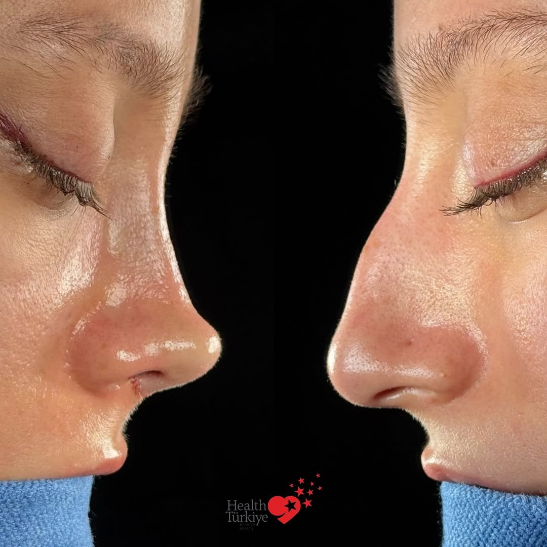 drfurkanozer 게시물 이미지: ✨ Transformation 

#rhinoplasty 

📌 We made a...