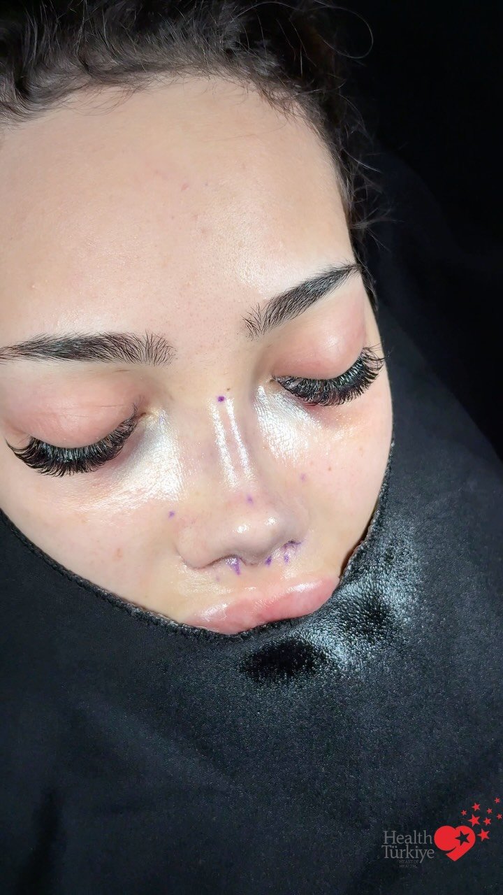 drfurkanozer 게시물 이미지: #rhinoplasty ⚡️

Dr. Furkan Özer Clinic is an...