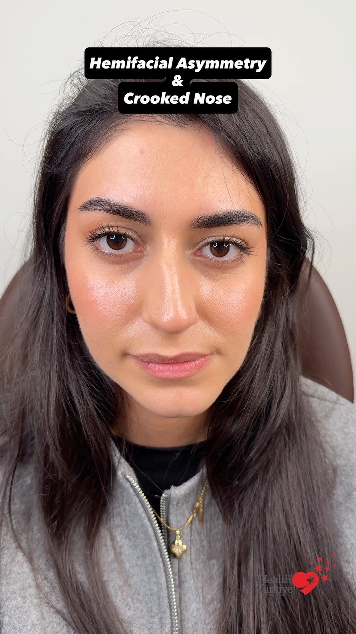 drfurkanozer 게시물 이미지: ❗️ A challenging case with hemifacial...