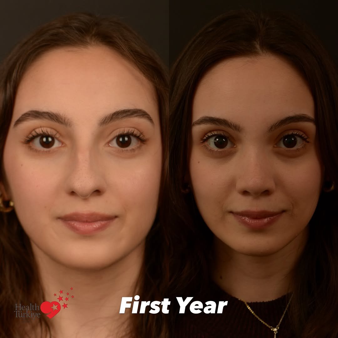 drfurkanozer 게시물 이미지: ❗️ First year / Natural Rhinoplasty...