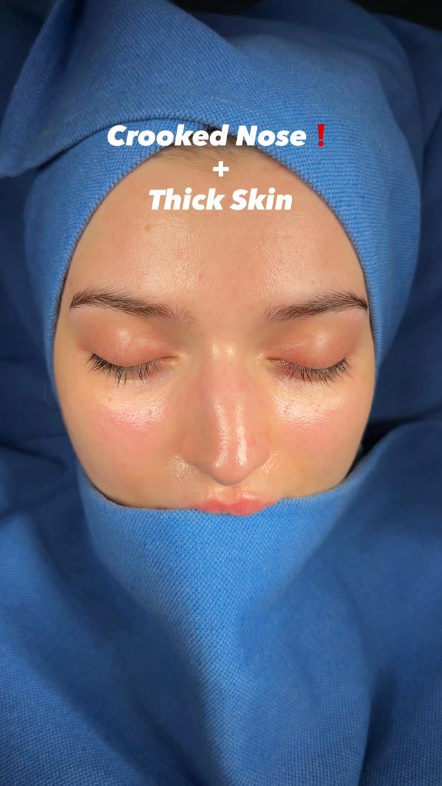 drfurkanozer 게시물 이미지: Crooked Nose correction ❗️

All of our...