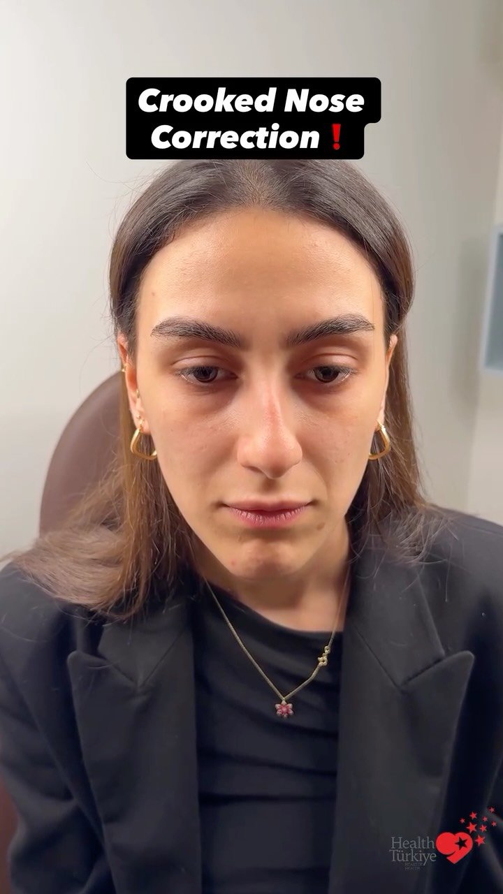 drfurkanozer 게시물 이미지: Crooked Nose Correction ❗️ 

⏳ 4th Month 

Dr....