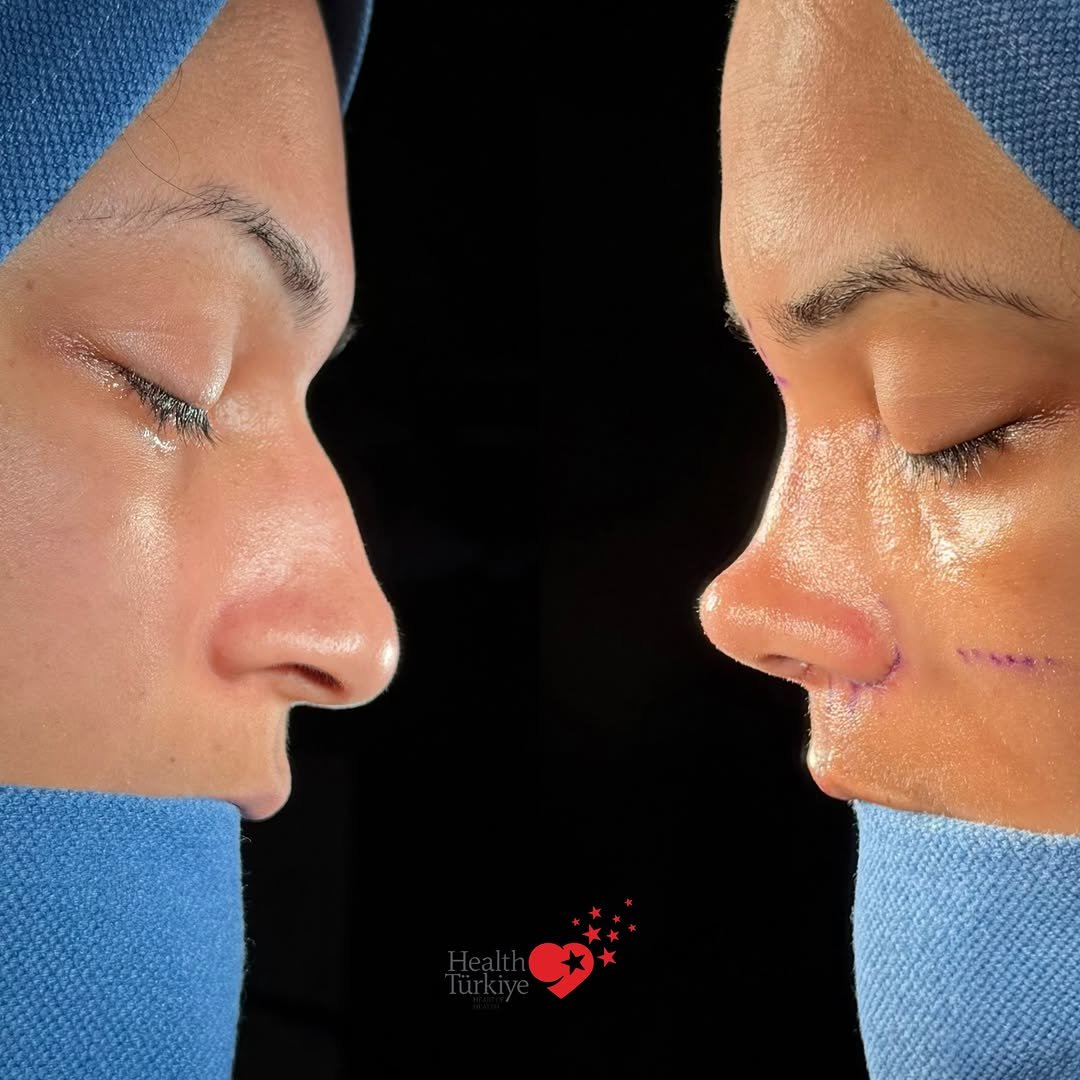 drfurkanozer 게시물 이미지: ⏩️ Swipe for more ⏩️

❗️Crooked nose...