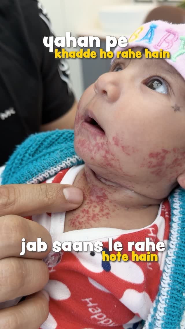 drimranpatelofficial 게시물 이미지: Hemangioma, laryngomalacia and umbilical...