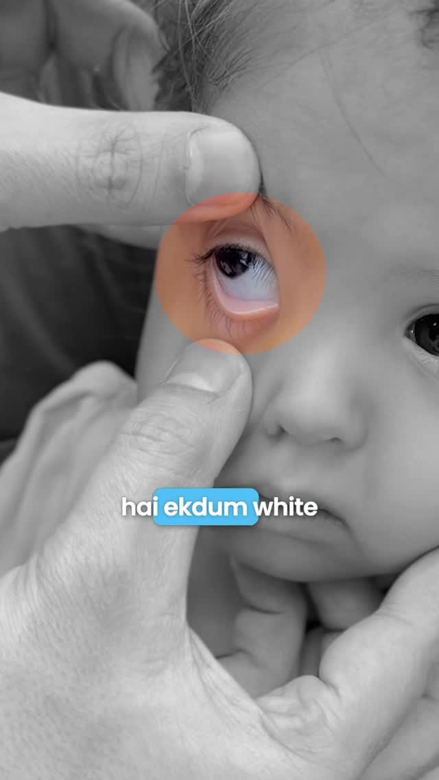 drimranpatelofficial 게시물 이미지: Pallor is not normal in children.
Don’t miss...