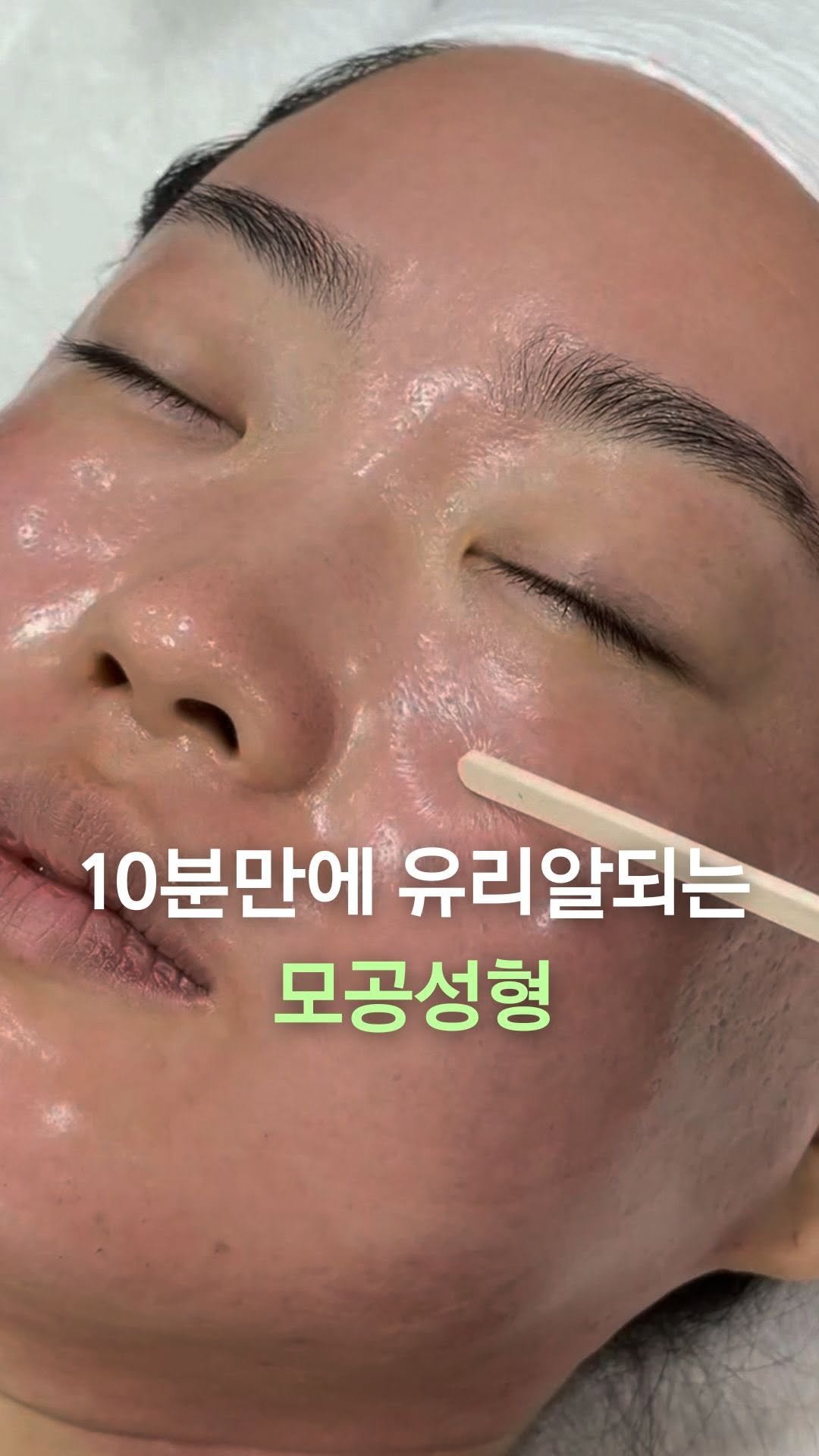 egmz86 게시물 이미지: 터질것 같은 이 피부
10분만에 10살 어려지는 이 관리

슈퍼젝션은 
피부 본연의...